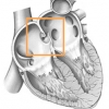Forame Ovale Pervio: il buco nel cuore. Cos'è e i suoi rischi.
