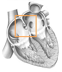 Forame Ovale Pervio: il buco nel cuore. Cos'è e i suoi rischi.