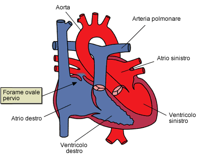 buco nel cuore, forame ovale pervio